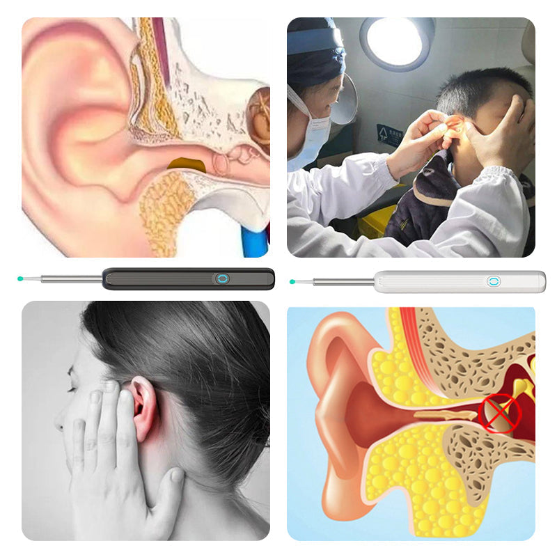 Ear wax remover with HD camera and app