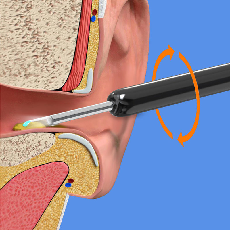 Ear wax remover with HD camera and app